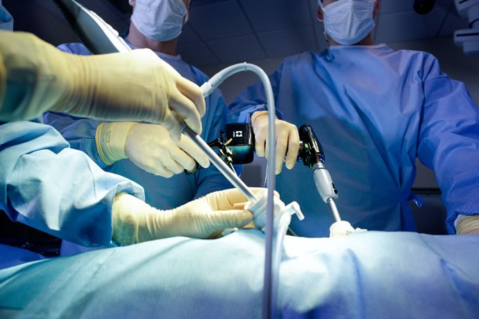 مزایای عمل جراحی پلیکاسیون معده